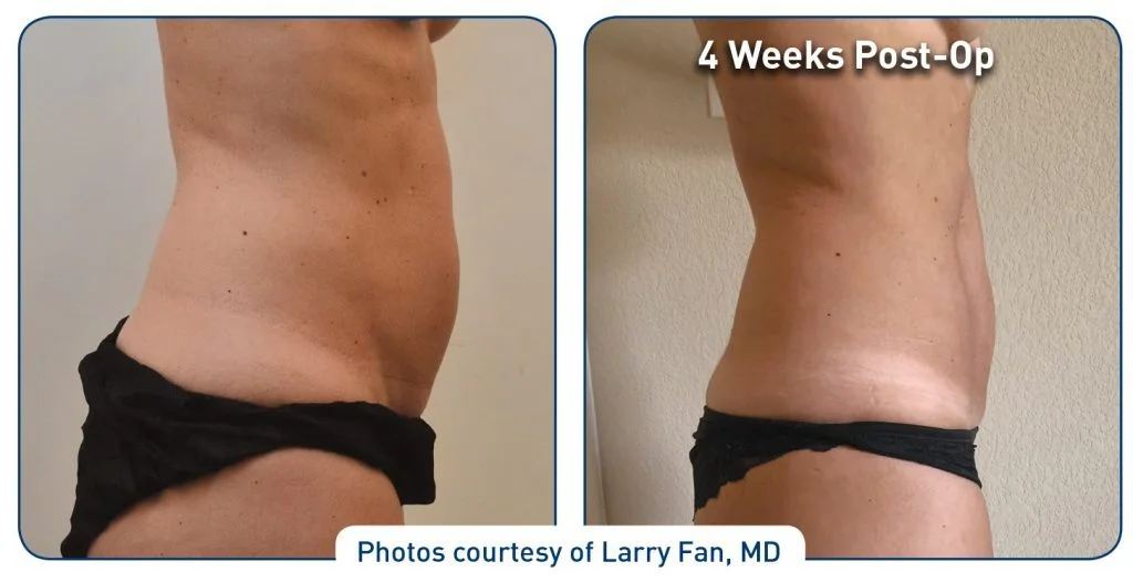 Abdominal before and after of Renuvion patient with a flatter stomach