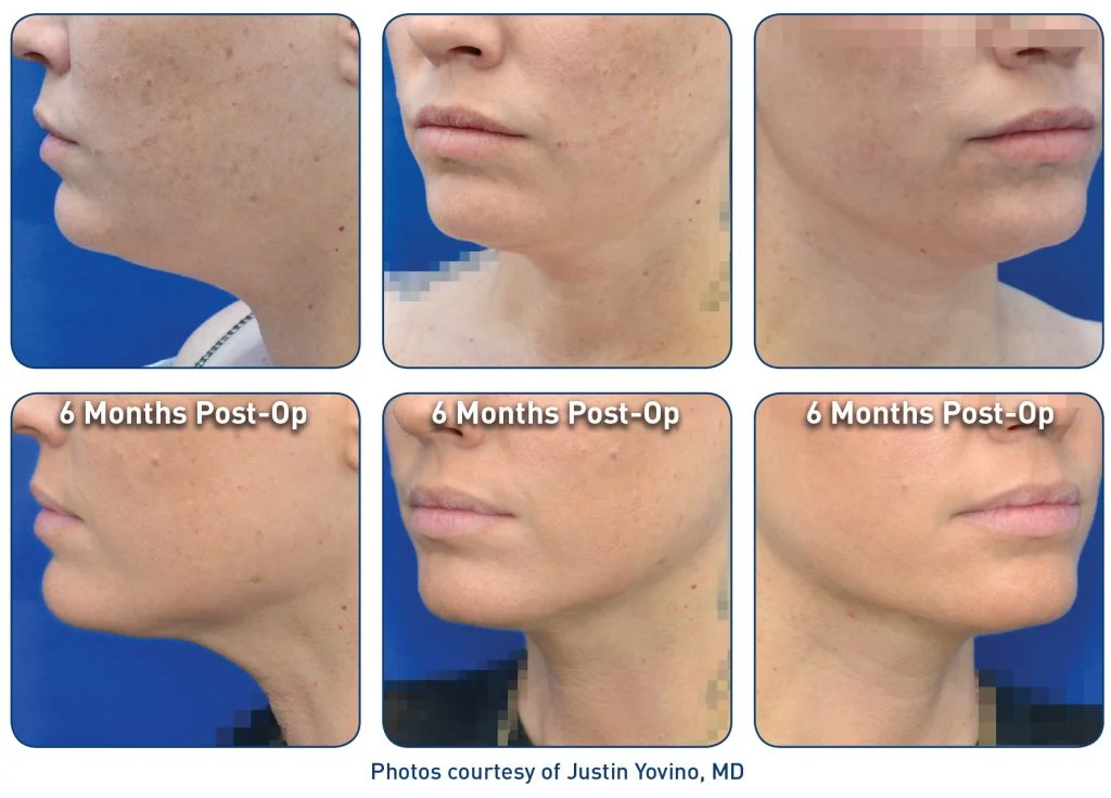 Double chin and defined jawline before and after photos shown six months post op with Renuvion skin tightening for face and body