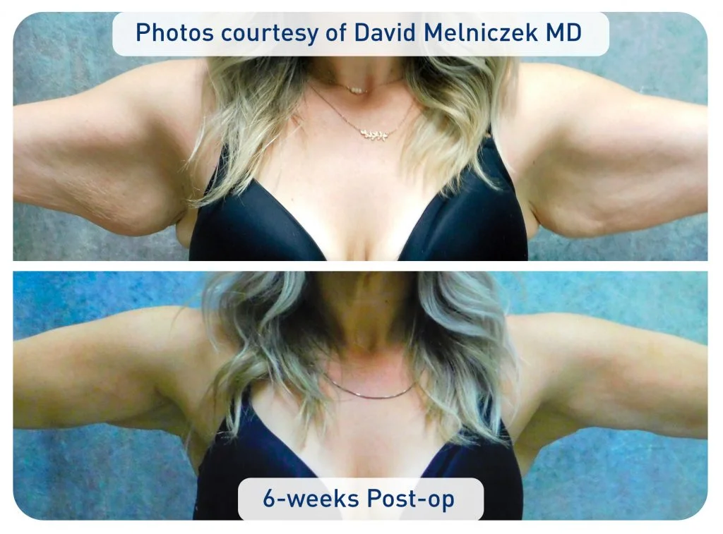 Before and after of woman's upper arms with tighter skin six weeks after the procedure Renuvion skin tightening for bat wings