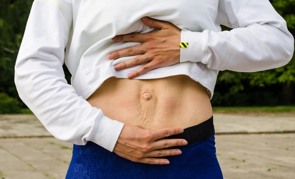 Should You Go for the Diastasis or Hernia Repair - Core Exercise Solutions