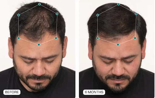 Man shown before and 6 months after taking Nutrafol supplements for hair growth