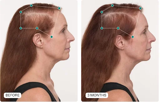 Woman shown before and 3 months after taking Nutrafol supplements for hair growth