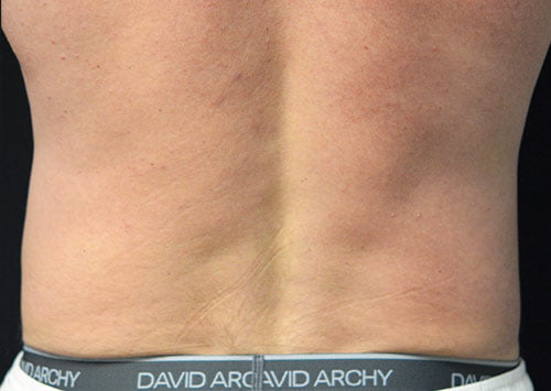 CoolSculpting