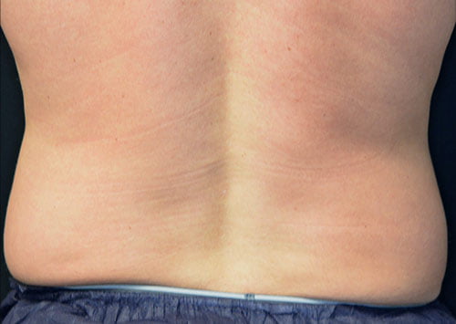 CoolSculpting