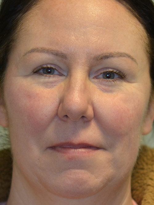 Facial Vascular Treatment