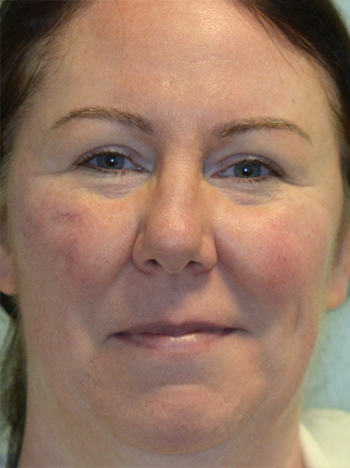 Facial Vascular Treatment