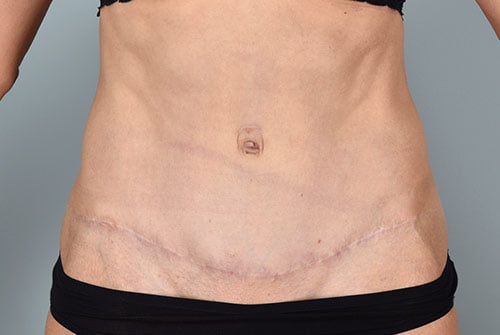 Tummy Tuck Patient 1001