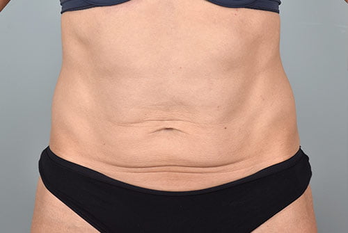 Tummy Tuck Patient 1001