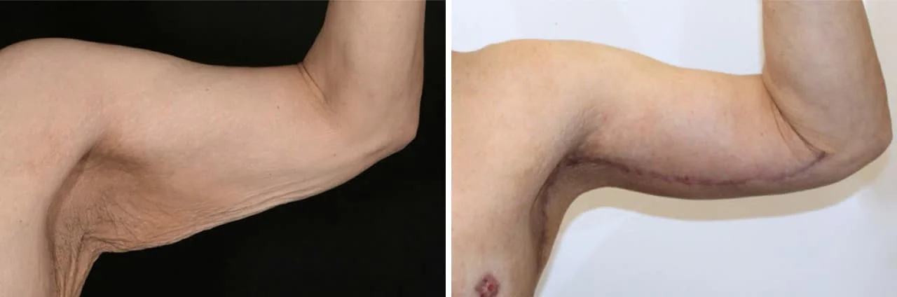 Boston Plastic Surgery arm lift before and after patient with scar hidden along the underside of the upper arm and underarm. Before photo shows loose, sagging skin on the arms and underarms, while the after photos shows smooth unwrinkled skin with a natural contour