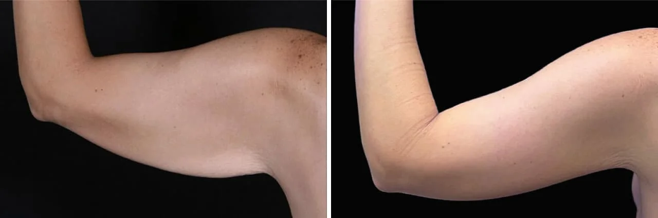 Before and after Boston Plastic Surgery's Boston arm lift patient with less loose skin "bat wing" appearance and a naturally slimmer, proportional arm contour