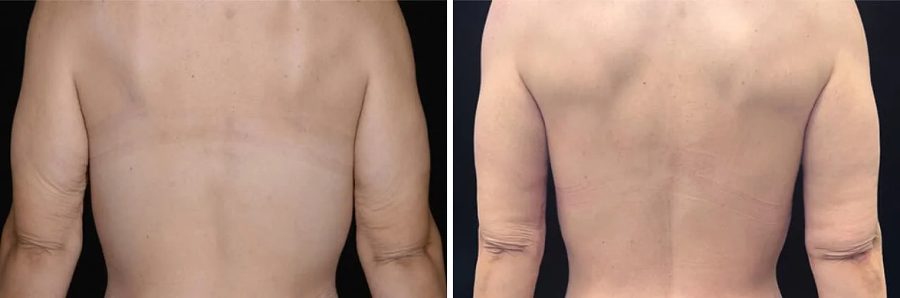 Before and after an arm lift at Boston Plastic Surgery, a patient's back shows drooping, wrinkled upper arm skin in the "before" photo and smoother, naturally contoured arms in the after photo