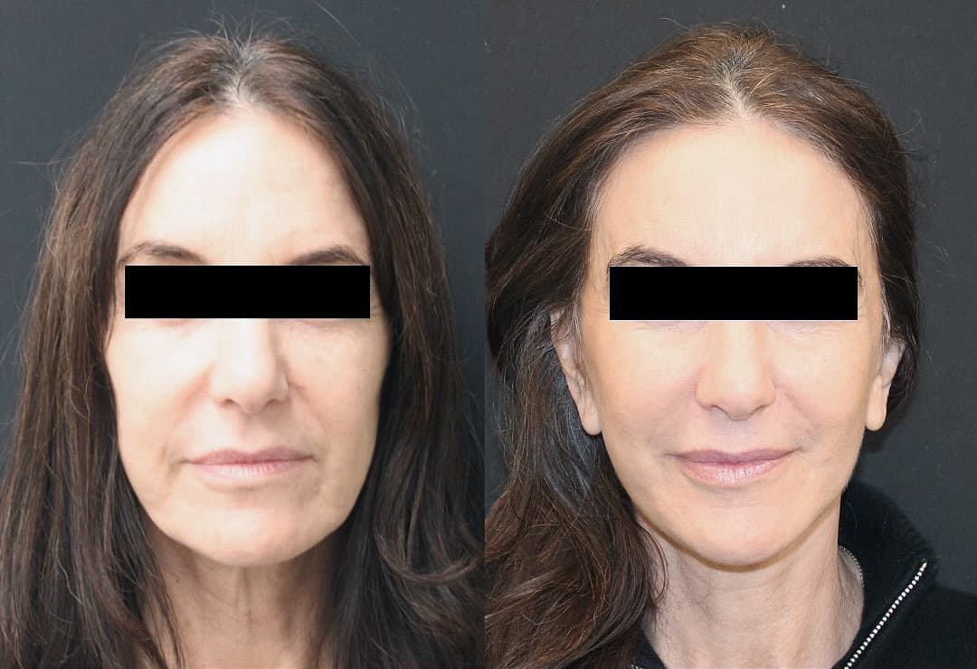 A before and after image of a Revision Facelift patient. The procedure was performed by Dr. Alannah Phelan of Boston Plastic Surgery.