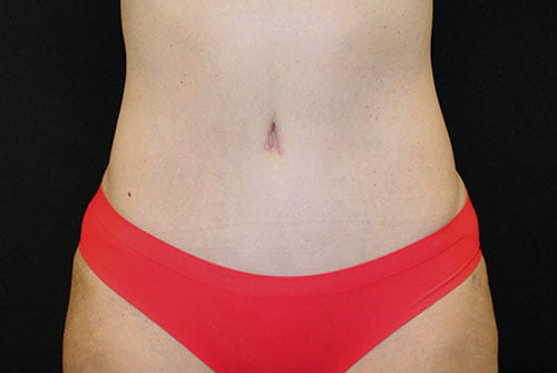 Tummy Tuck with 360 Liposuction