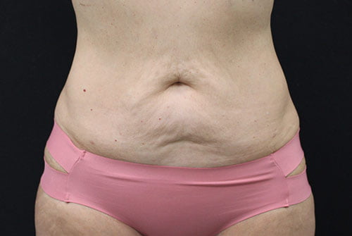 Tummy Tuck with 360 Liposuction