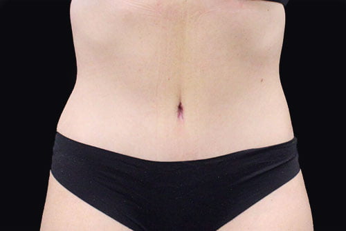 Tummy Tuck with 360 Liposuction