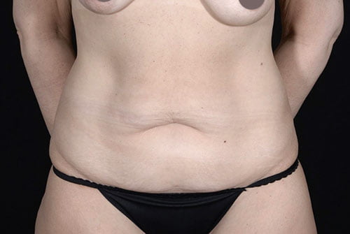 Tummy Tuck with 360 Liposuction