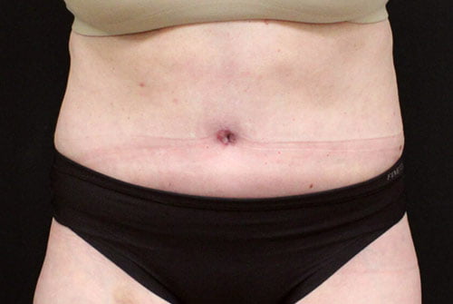 Tummy Tuck with 360 Liposuction