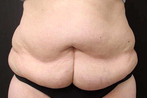 Tummy Tuck with 360 Liposuction