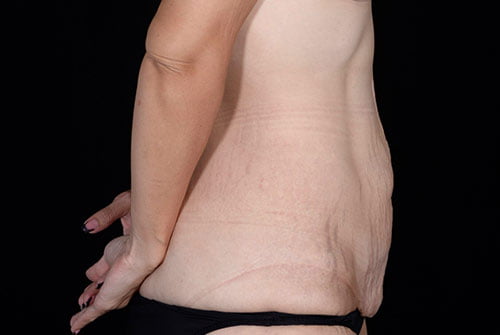 Tummy Tuck