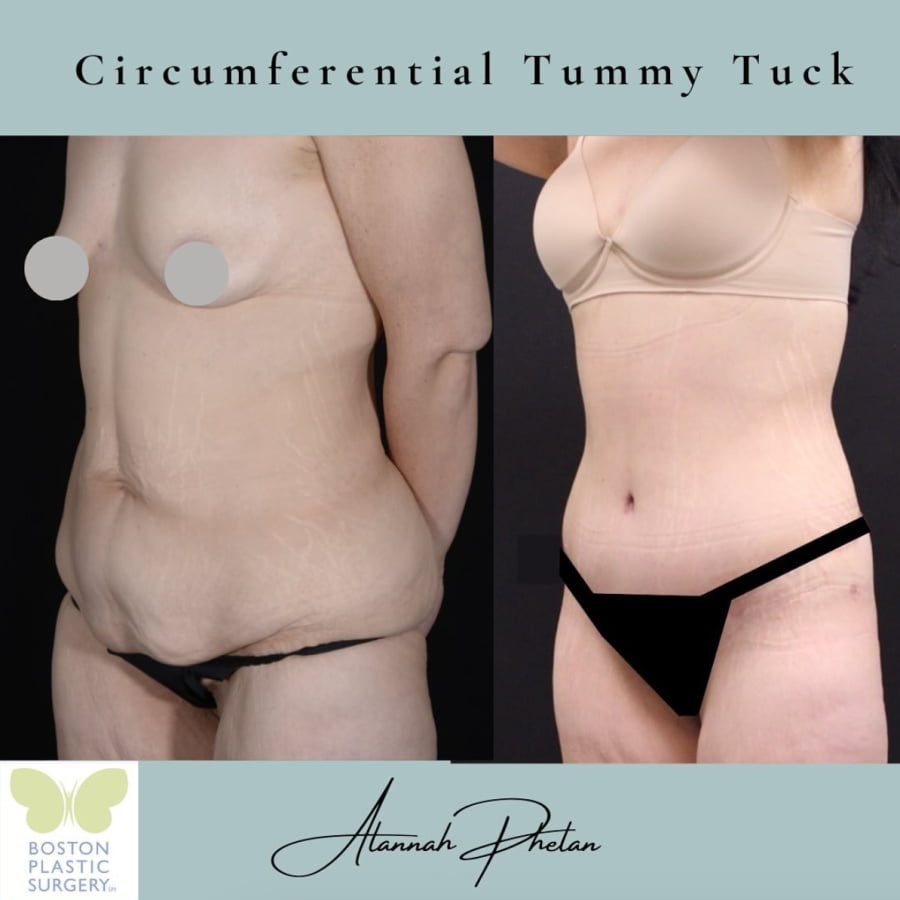 Female patient before and after circumferential tummy tuck with Boston plastic surgeon Dr. Alannah Phelan