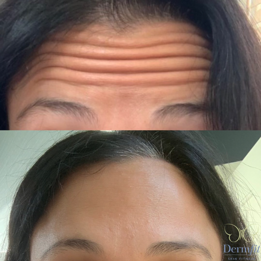 Forehead before and after Dysport treatment at Boston Plastic Surgery's Skin Wellness Center