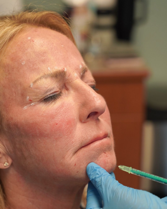 Woman getting chin filler at Boston Plastic Surgery