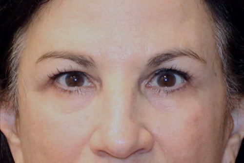 Eyelid Surgery