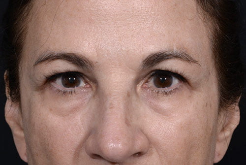 Eyelid Surgery