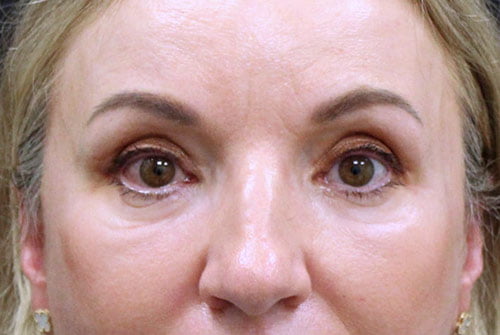 Eyelid Surgery