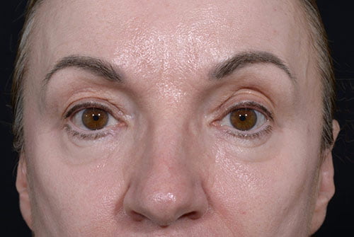 Eyelid Surgery