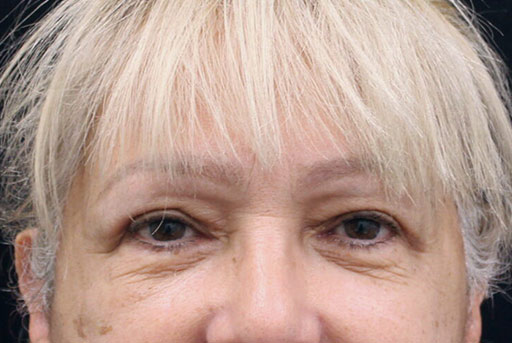 Eyelid Surgery