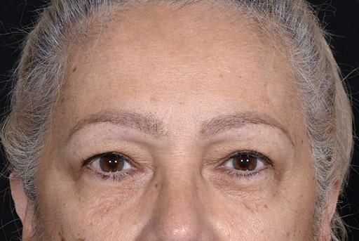 Eyelid Surgery