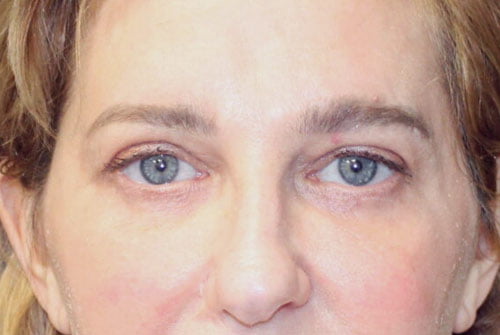 Eyelid Surgery