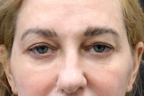 Eyelid Surgery