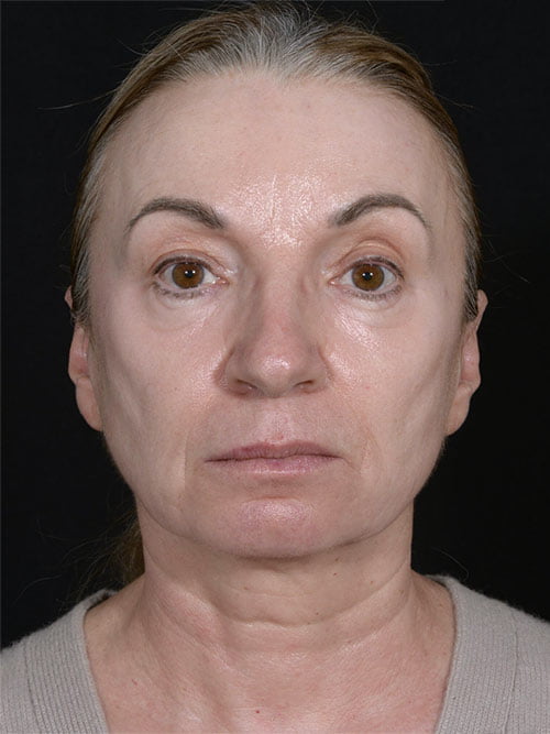 Facelift, Neck Lift, Eyelid Surgery