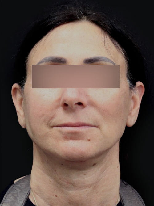 Facelift and Neck Lift