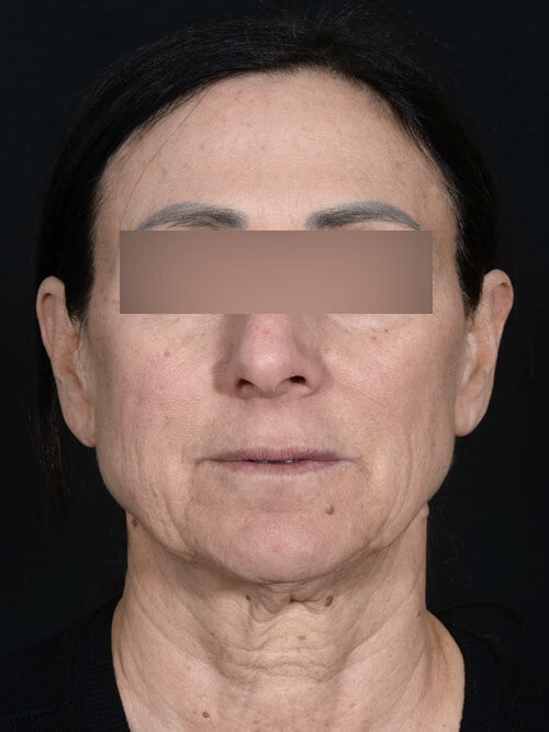 Facelift and Neck Lift