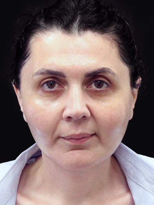 Facelift & Neck Lift