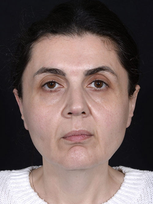 Facelift & Neck Lift