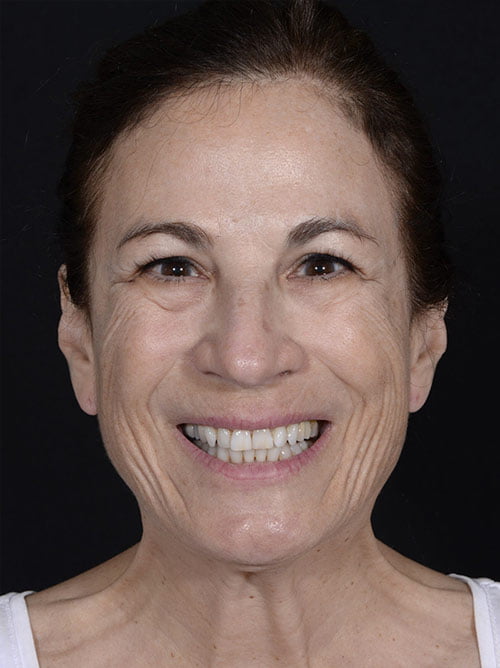 Facelift, Neck Lift, Eye Surgery