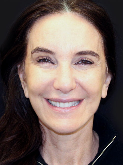 Facelift and Neck Lift Revision