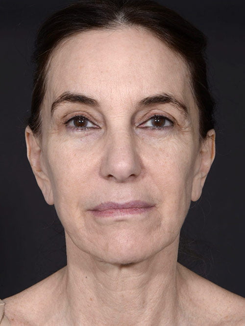 Facelift and Neck Lift Revision