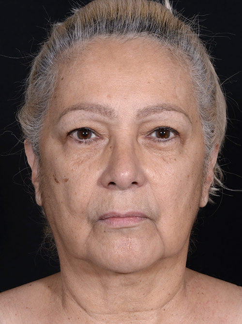 Facelift, Neck Lift, Eye Surgery