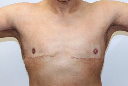 Male Breast Reduction