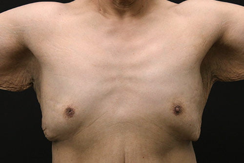 Male Breast Reduction