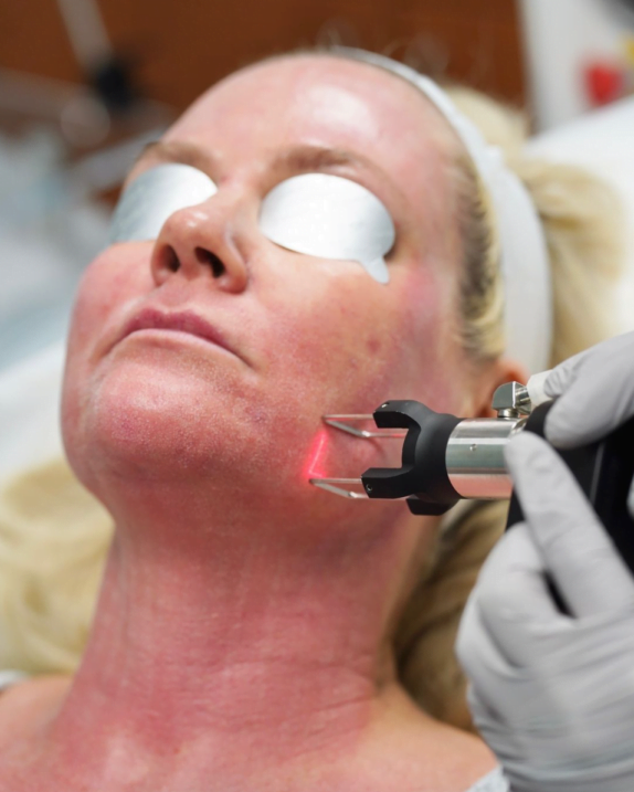 Woman getting a laser skin treatment at the Skin Wellness Center at Boston Plastic Surgery