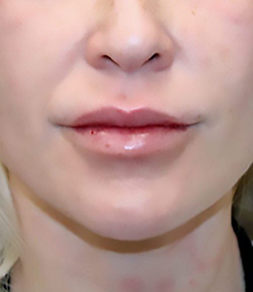 Lip Filler Revision Volbella