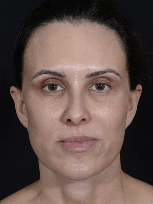 Rhinoplasty