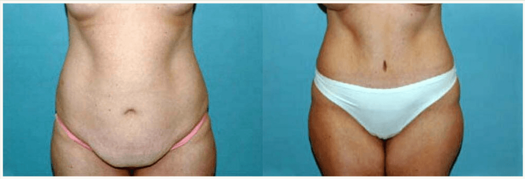 Before and after tummy tuck at Boston Plastic Surgery